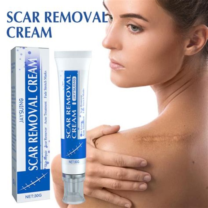 Are there creams to remove scars?