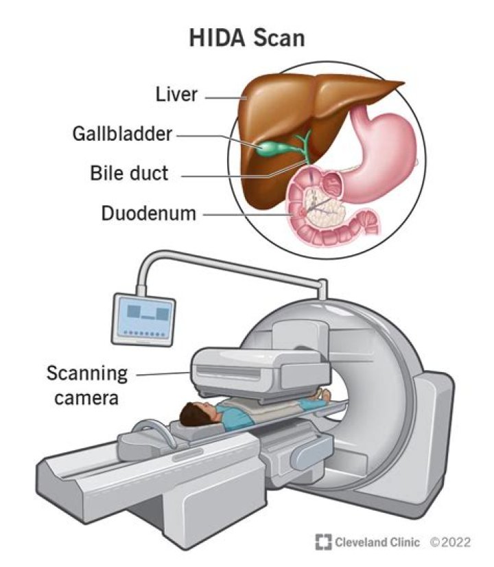 Can a HIDA scan detect liver problems?