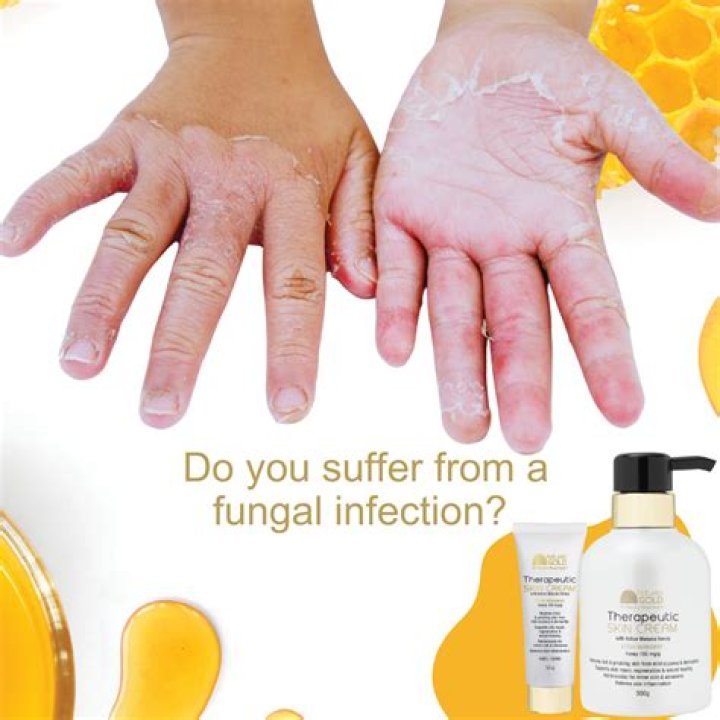 Can manuka honey help fungal infections?
