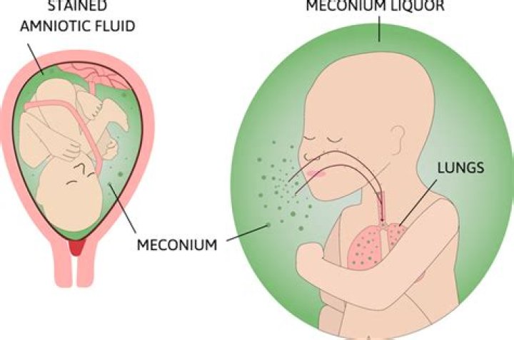Can meconium cause infection?