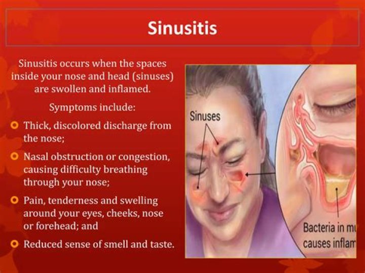 Can sinus issues make you nauseous?