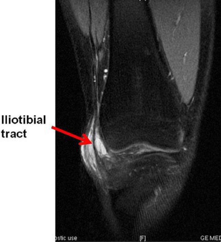 Does iliotibial band syndrome show up on MRI?