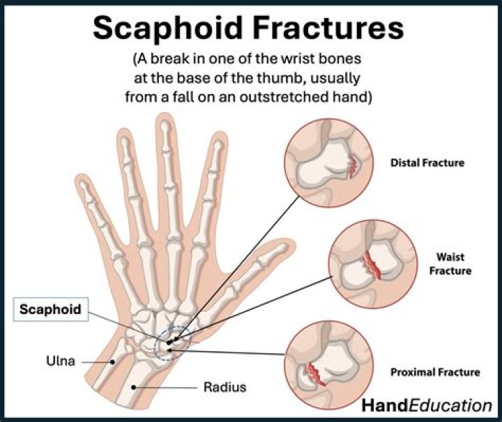 How do you know if your scaphoid is fractured?