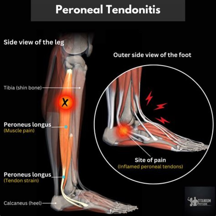 How do you treat a torn tendon in your thigh?