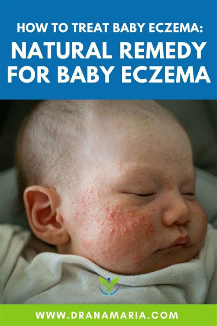 How do you treat baby eczema?