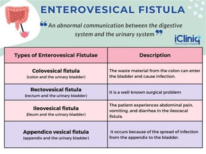 How do you treat Vesicovaginal fistula?