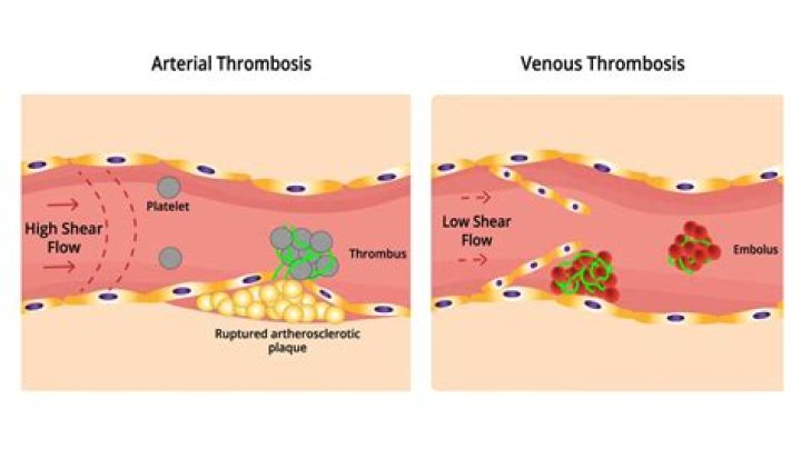 How does APS cause thrombosis?