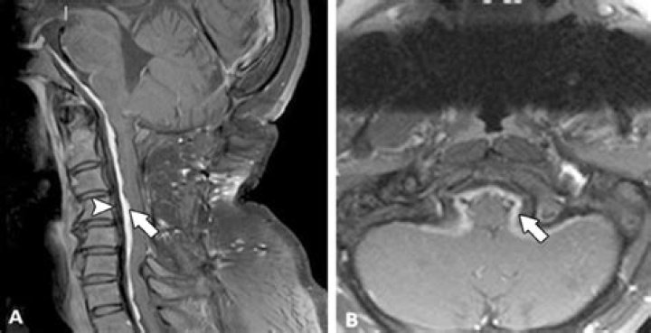 How is Pachymeningitis treated?