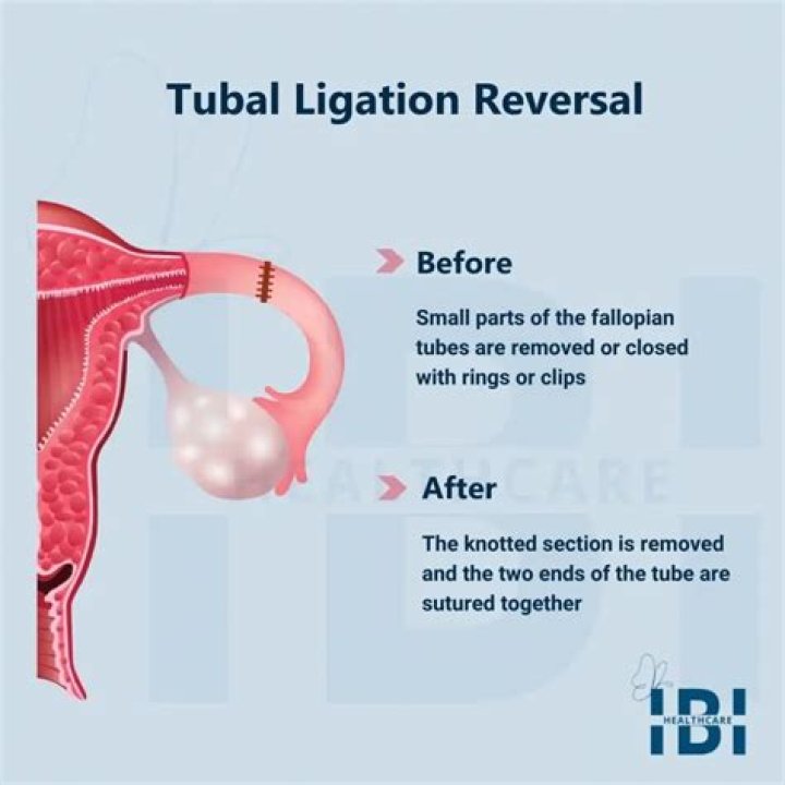 How long does it take for tubes to heal after tubal reversal?