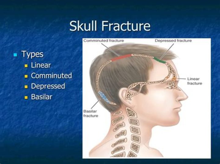 How serious is a basal skull fracture?