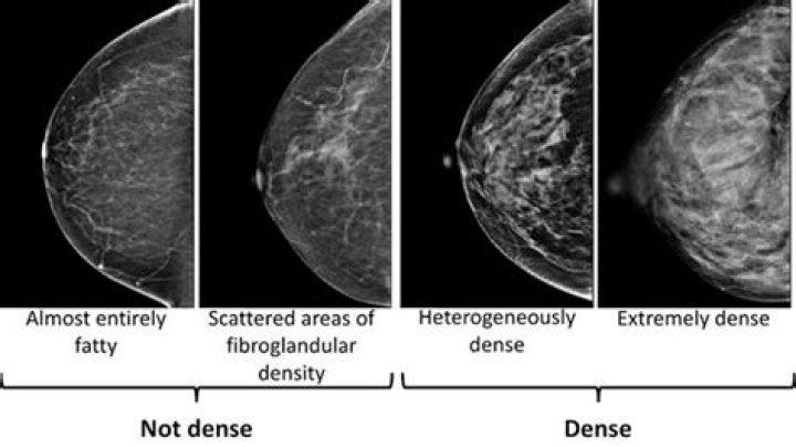 Is it normal for dense breast tissue to hurt?