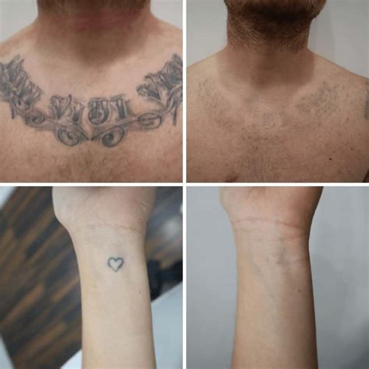 Is it possible to 100% remove a tattoo?