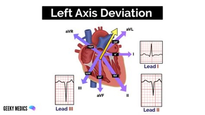 Is left axis deviation a concern?