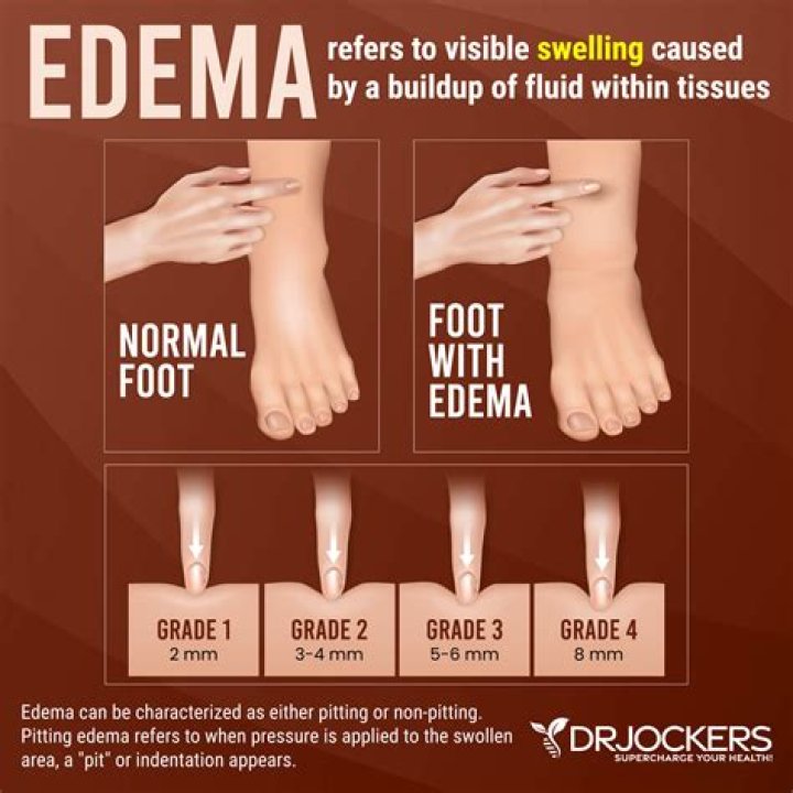 What are the grade of edema?