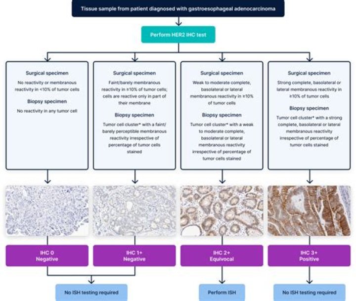 What are the major criteria in diagnosing adenocarcinoma in biopsy?
