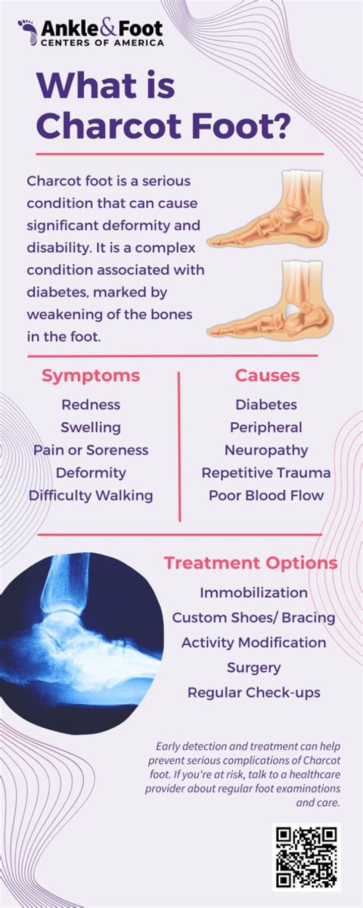 What are the three stages of Charcot foot?