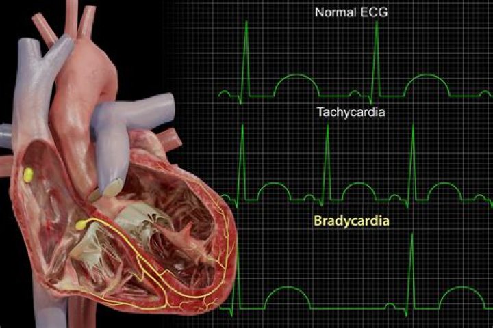 What causes junctional bradycardia?