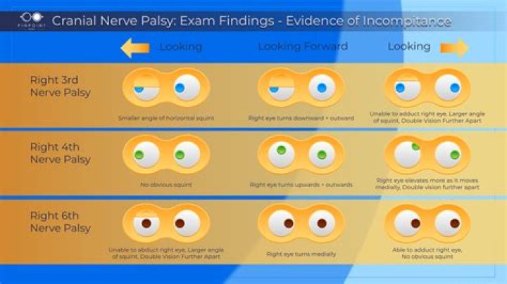 What causes nerve palsies?