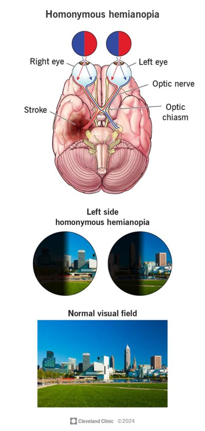 What causes unilateral hemianopia?