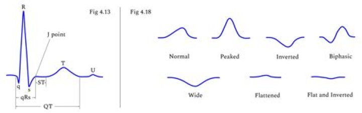 What does it mean when the T wave is inverted?
