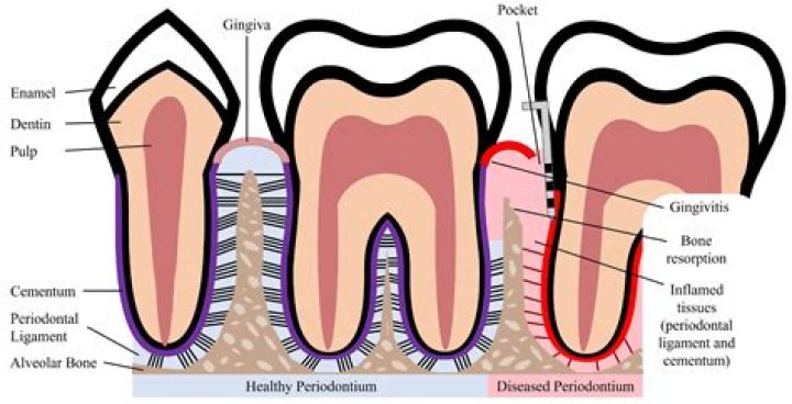 What factors contribute to periodontal disease?