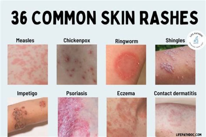 What is a rash that looks like a circle?