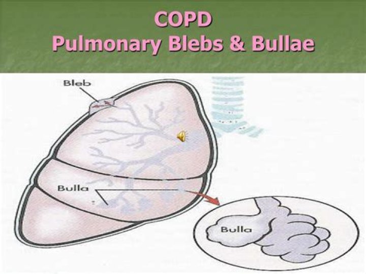 What is a subpleural bleb?