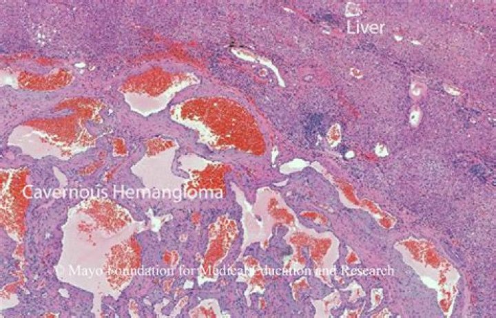 What is epithelioid hemangioendothelioma liver?