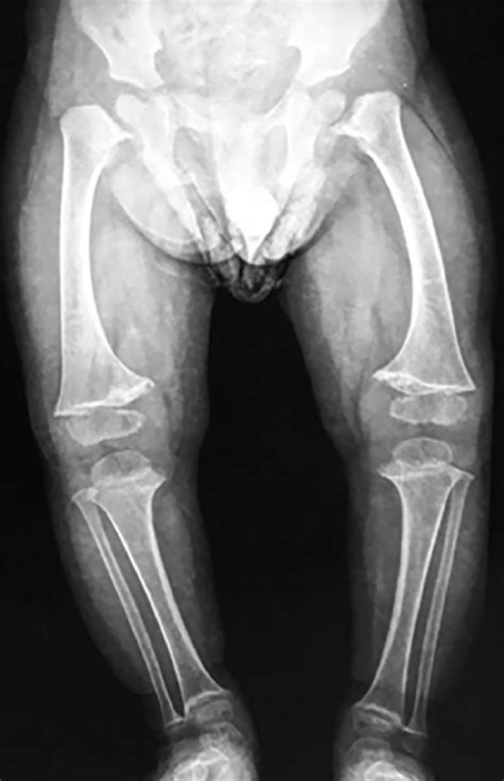 What is metaphyseal Chondrodysplasia?