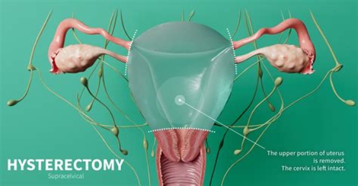 What is salpingectomy and how does it work?