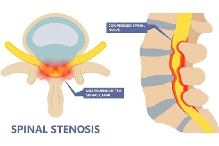 What is the most common treatment for spinal stenosis?