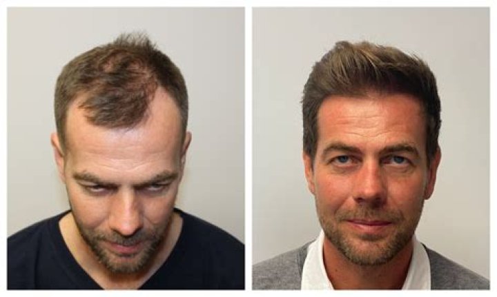 What is the most effective hair transplant?