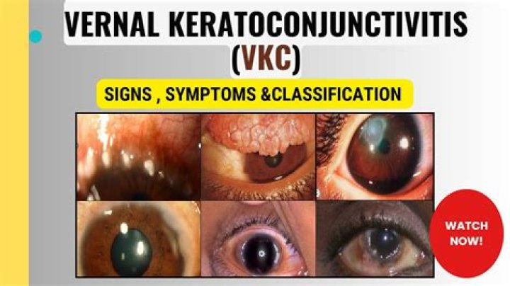 What is variablevernal keratoconjunctivitis (VKC)?