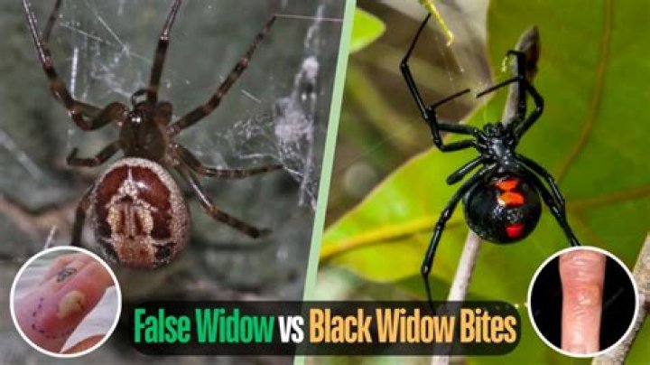 What to do if a false widow bites you?