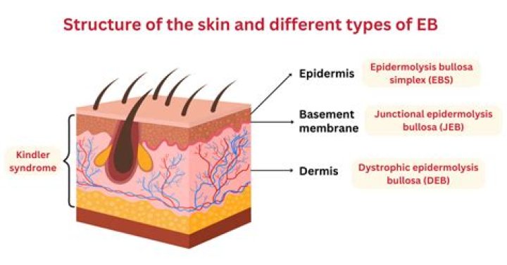 What type of tissue is affected by epidermolysis bullosa EB?