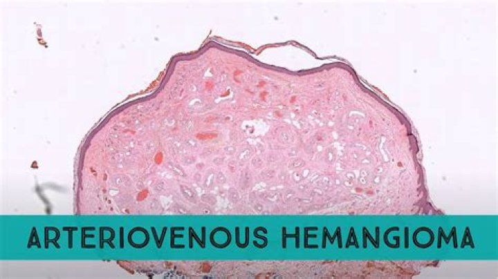 When should a liver hemangioma be removed?