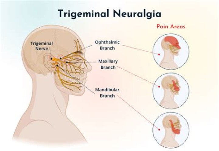 Who is the best doctor for trigeminal neuralgia?